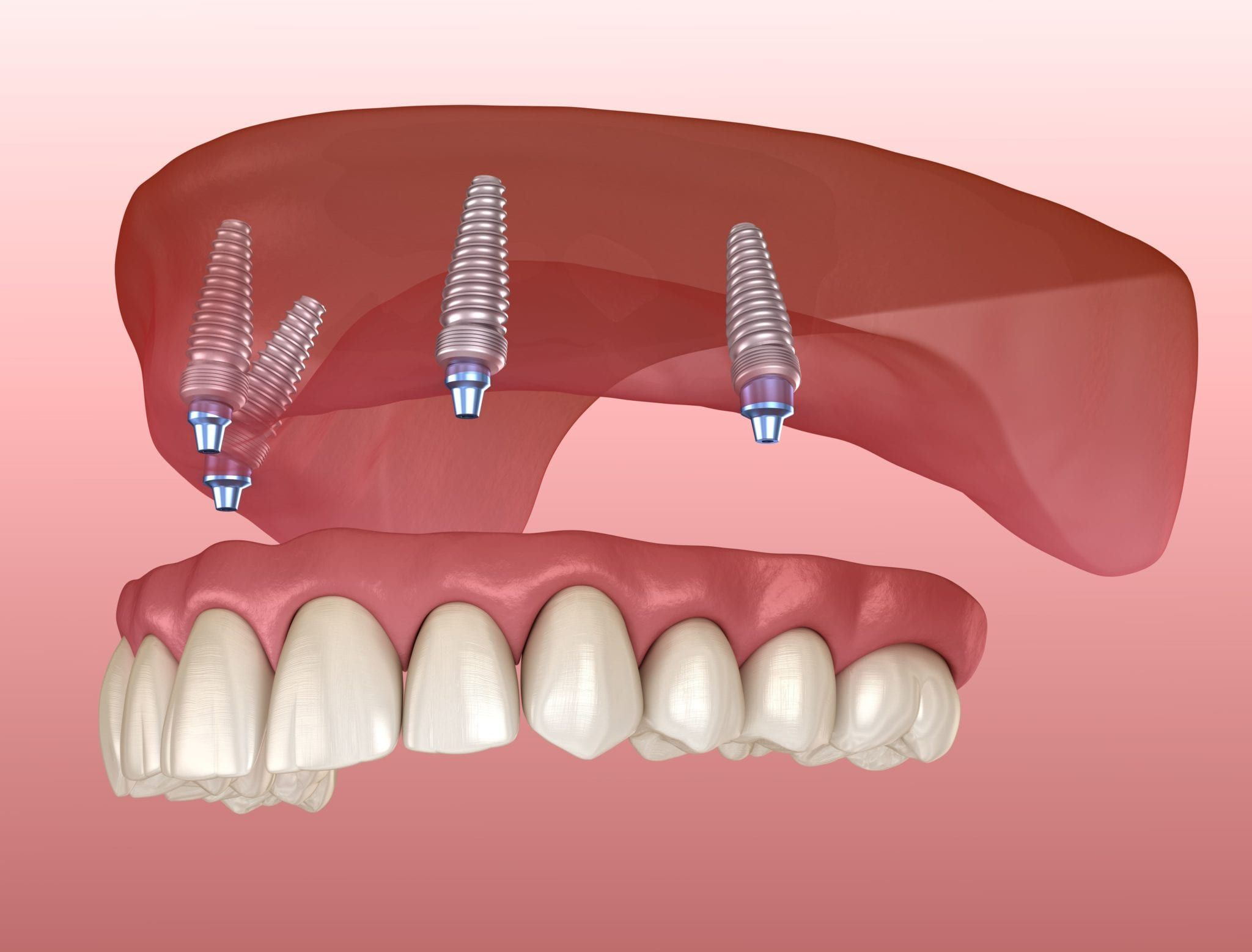 Implant Dentures