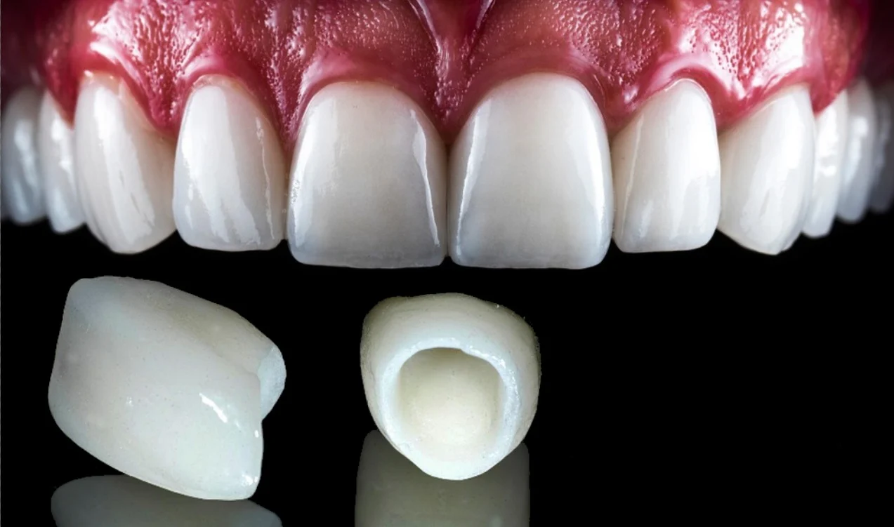 E-Max Crowns