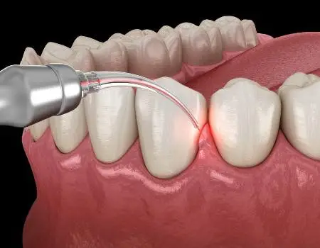 Laser Periodontal Therapy